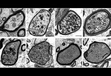 Desvelan mecanismos moleculares de la esclerosis múltiple Desvelan mecanismos moleculares de la esclerosis múltiple
