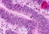 Nuevos marcadores génicos para identificar cáncer colorrectal Nuevos marcadores génicos para identificar cáncer colorrectal