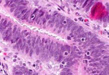 Nuevos marcadores génicos para identificar cáncer colorrectal Nuevos marcadores génicos para identificar cáncer colorrectal