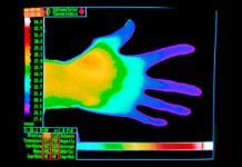Dos genes causan el síndrome de Raynaud Dos genes causan el síndrome de Raynaud