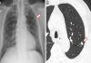 Identifican con IA a no fumadores con alto riesgo de cáncer Identifican con IA a no fumadores con alto riesgo de cáncer