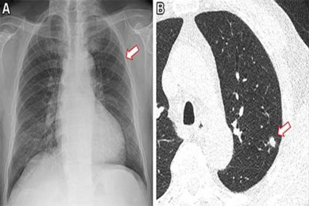 Identifican con IA a no fumadores con alto riesgo de cáncer