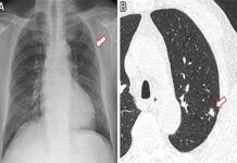 Identifican con IA a no fumadores con alto riesgo de cáncer Identifican con IA a no fumadores con alto riesgo de cáncer