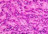 Análisis génico pionero para el cáncer gástrico difuso hereditario Análisis génico pionero para el cáncer gástrico difuso hereditario