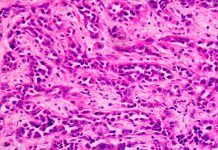 Análisis génico pionero para el cáncer gástrico difuso hereditario Análisis génico pionero para el cáncer gástrico difuso hereditario