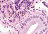 Detectan con IA un tipo más agresivo de cáncer de próstata Detectan con IA un tipo más agresivo de cáncer de próstata