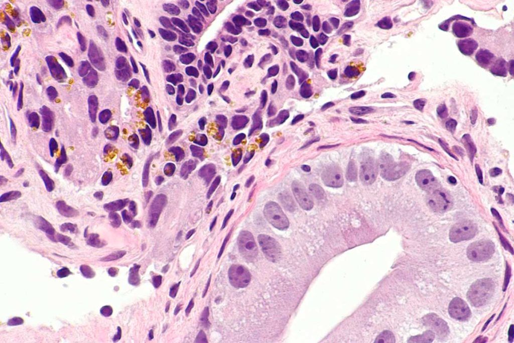 Detectan con IA un tipo más agresivo de cáncer de próstata