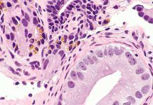 Detectan con IA un tipo más agresivo de cáncer de próstata Detectan con IA un tipo más agresivo de cáncer de próstata