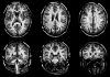 Visualizan con más claridad el daño de la esclerosis múltiple en el cerebro Visualizan con más claridad el daño de la esclerosis múltiple en el cerebro