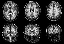 Visualizan con más claridad el daño de la esclerosis múltiple en el cerebro Visualizan con más claridad el daño de la esclerosis múltiple en el cerebro