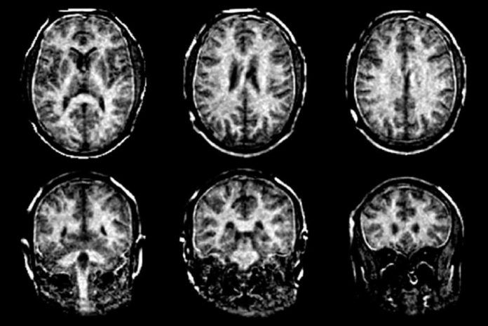 Visualizan con más claridad el daño de la esclerosis múltiple en el cerebro