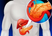 Con un páncreas pequeño la progresión a diabetes 1 es más rápida Con un páncreas pequeño la progresión a diabetes 1 es más rápida