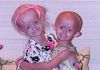 Definiendo la progeria Definiendo la progeria