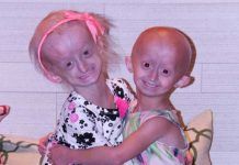 Definiendo la progeria Definiendo la progeria