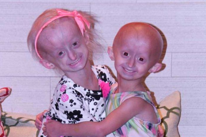 progeria Definiendo la progeria