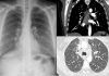 Sarcoidosis: nuevo análisis de sangre para detectar con rapidez una enfermedad mortal Sarcoidosis: nuevo análisis de sangre para detectar con rapidez una enfermedad mortal
