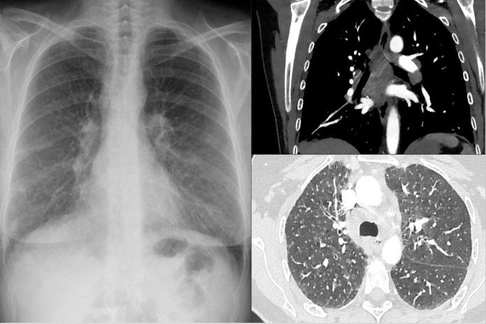 Sarcoidosis: nuevo análisis de sangre para detectar con rapidez una enfermedad mortal