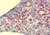 Criptococosis: nueva directriz para diagnosticar y tratar una meningitis peligrosa Criptococosis: nueva directriz para diagnosticar y tratar una meningitis peligrosa