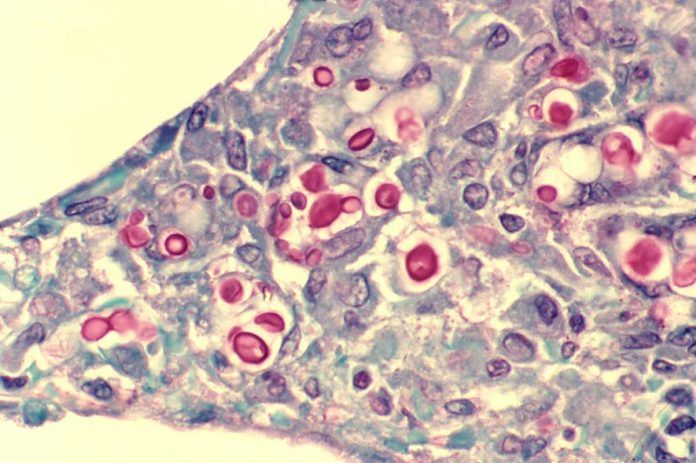 Criptococosis Criptococosis: nueva directriz para diagnosticar y tratar una meningitis peligrosa