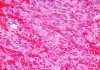 Primer paso para tratar el sarcoma de Kaposi Primer paso para tratar el sarcoma de Kaposi