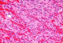 Primer paso para tratar el sarcoma de Kaposi Primer paso para tratar el sarcoma de Kaposi