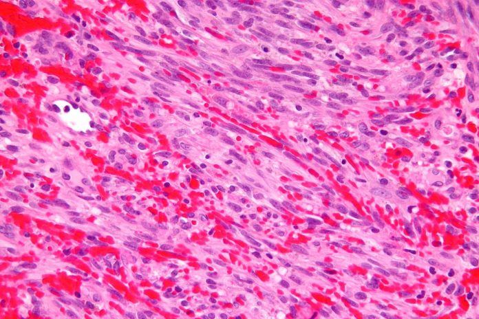 Kaposi_sarcoma Primer paso para tratar el sarcoma de Kaposi