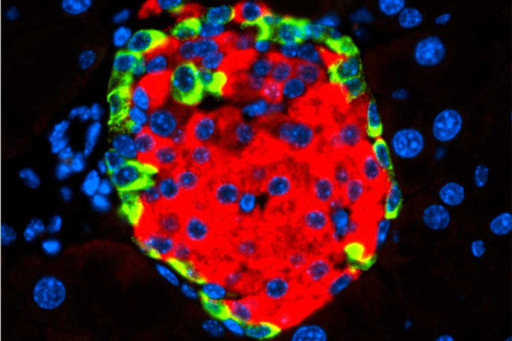 ¿Es un virus la causa de la diabetes 1?