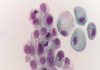 Análisis de orina para seguir la evolución del cáncer de vejiga Análisis de orina para seguir la evolución del cáncer de vejiga