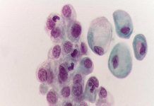 Análisis de orina para seguir la evolución del cáncer de vejiga Análisis de orina para seguir la evolución del cáncer de vejiga