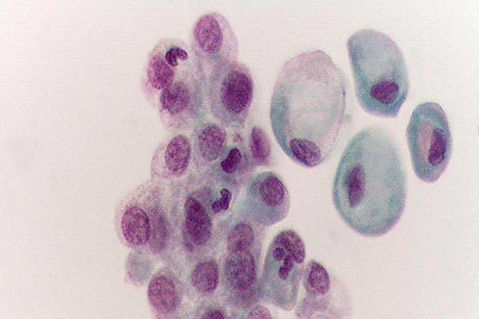 Análisis de orina para seguir la evolución del cáncer de vejiga