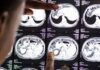 Innovador fármaco frente al glioma Innovador fármaco frente al glioma