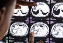 Innovador fármaco frente al glioma Innovador fármaco frente al glioma