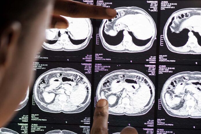 cerebro Innovador fármaco frente al glioma