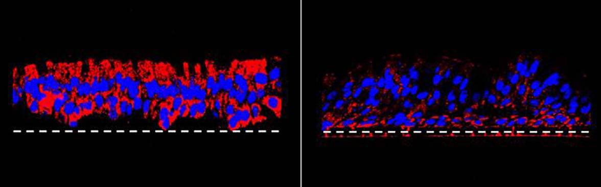 ¿Por qué las infecciones persisten en la fibrosis quística?