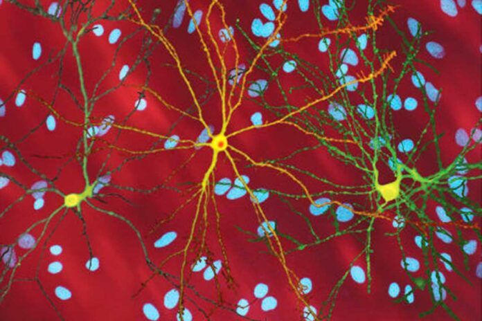 Hacia un tratamiento para la enfermedad neurodegenerativa de Huntington