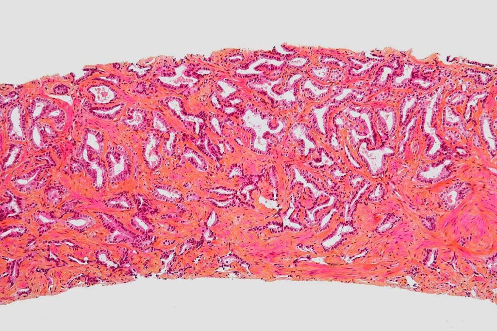 Innovadora prueba génica para cáncer de próstata de alto grado