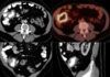 Detectan el 90 % de casos de cáncer linfático con IA Detectan el 90 % de casos de cáncer linfático con IA