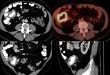Detectan el 90 % de casos de cáncer linfático con IA Detectan el 90 % de casos de cáncer linfático con IA