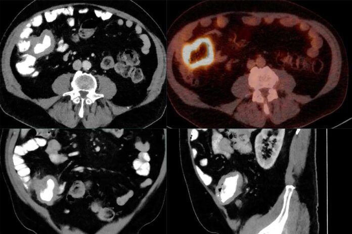 Detectan el 90 % de casos de cáncer linfático con IA