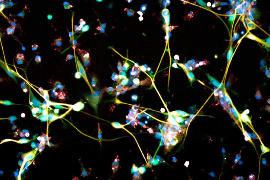 Un viejo antidepresivo, eficaz contra el glioblastoma