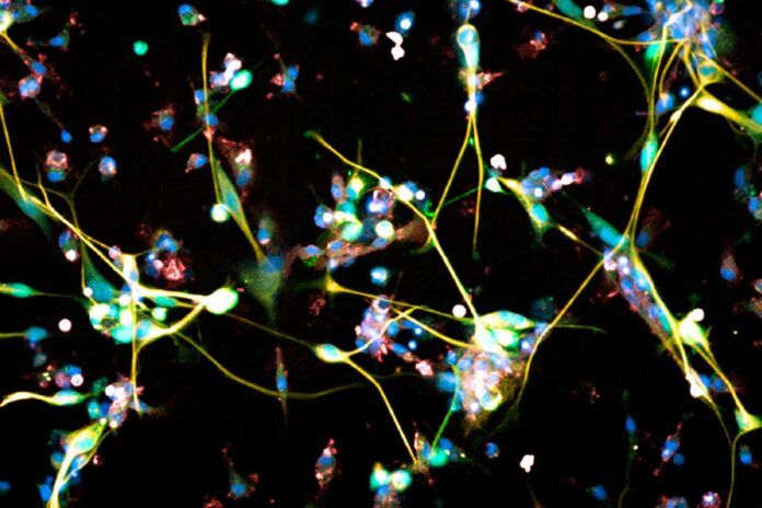 Un viejo antidepresivo, eficaz contra el glioblastoma