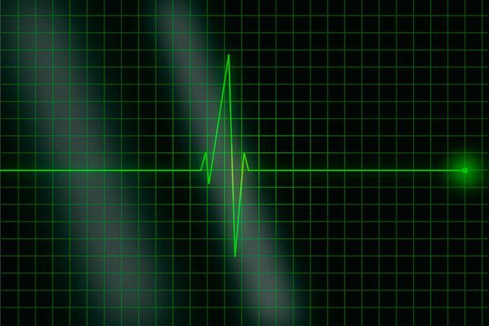electrocardiograma ¿Se puede evitar la muerte súbita cardíaca?