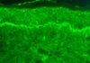 Descubren el mecanismo molecular del lupus Descubren el mecanismo molecular del lupus