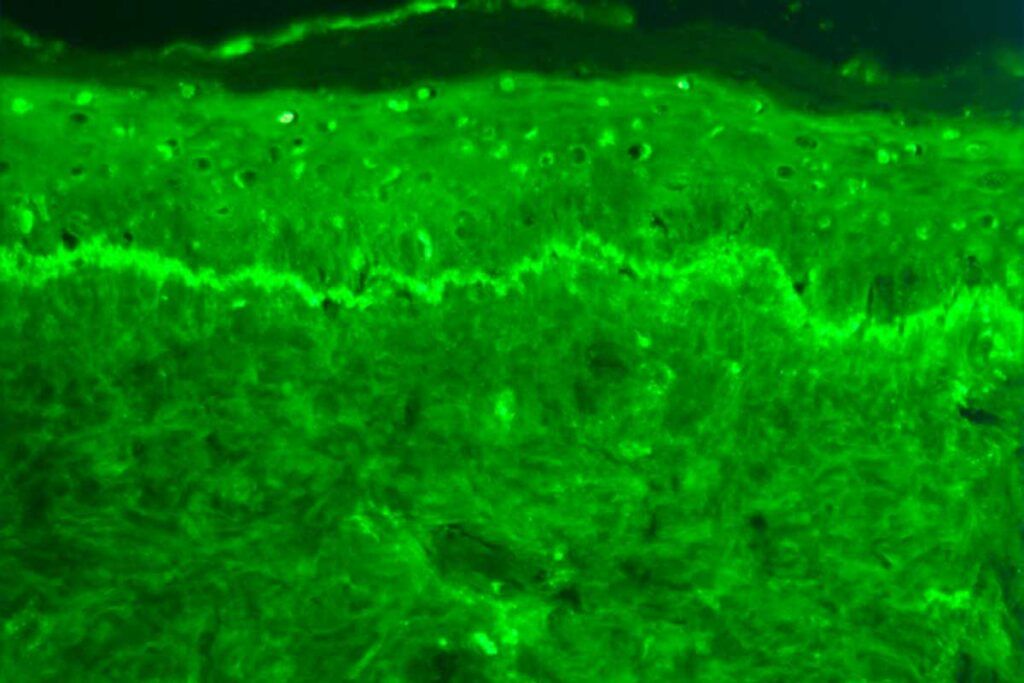 Descubren el mecanismo molecular del lupus