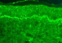 Descubren el mecanismo molecular del lupus Descubren el mecanismo molecular del lupus