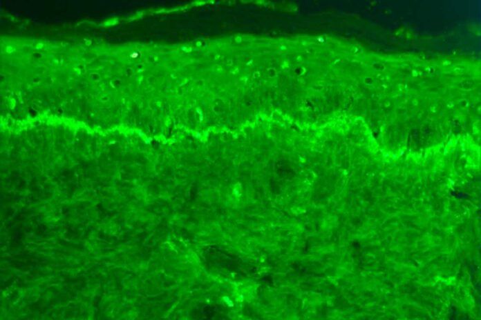 Descubren el mecanismo molecular del lupus
