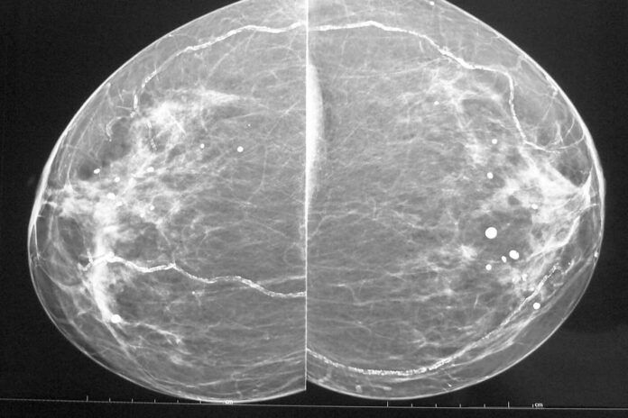 mamografia La mamografía detecta también enfermedad cardíaca