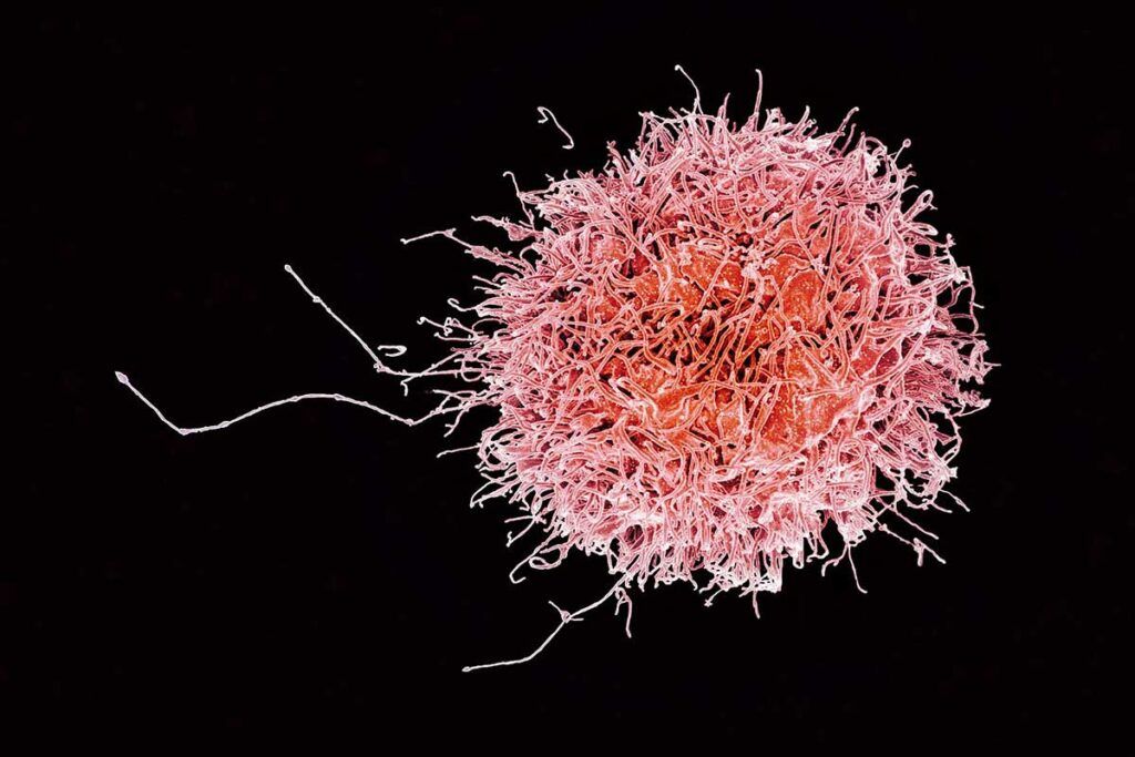 ‘Células asesinas’, eficaces contra la leucemia mieloide aguda