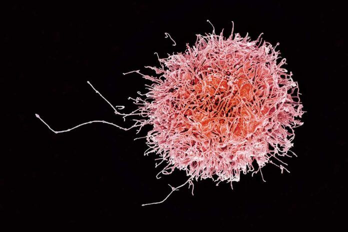 natural-killer ‘Células asesinas’, eficaces contra la leucemia mieloide aguda