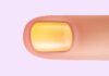 Síndrome de las uñas amarillas: identificada la causa génica Síndrome de las uñas amarillas: identificada la causa génica